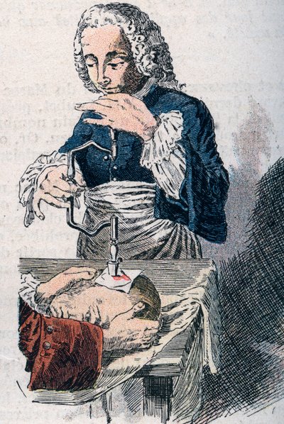 Trepanace. tisk z 18. století. od Unknown artist