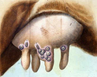 Luigi Sacco (1769-1836) v lednu 1801 použil kravský prs k naočkování vakcíny proti neštovicím. Medicínská deska z „“ Vaccination Treat“ od Luigi Sacco, Milán od Unknown artist