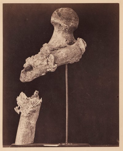 Poručík Goodwin, zemřelý, neúplná střelná zlomenina horní třetiny pravé stehenní kosti, sedm měsíců po zranění, z fotografického katalogu chirurgické sekce od William Bell