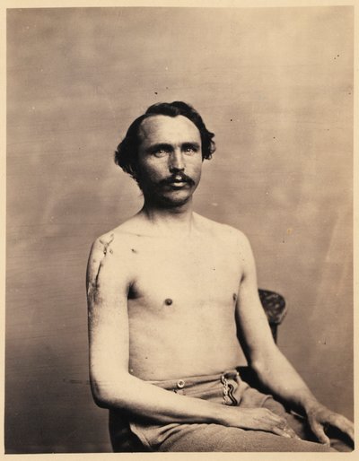 Vojín Adolph Zirsse, úspěšná střední excize hlavice a dvou a půl palce dříku pravé kosti pažní, z fotografického katalogu chirurgické sekce od William Bell