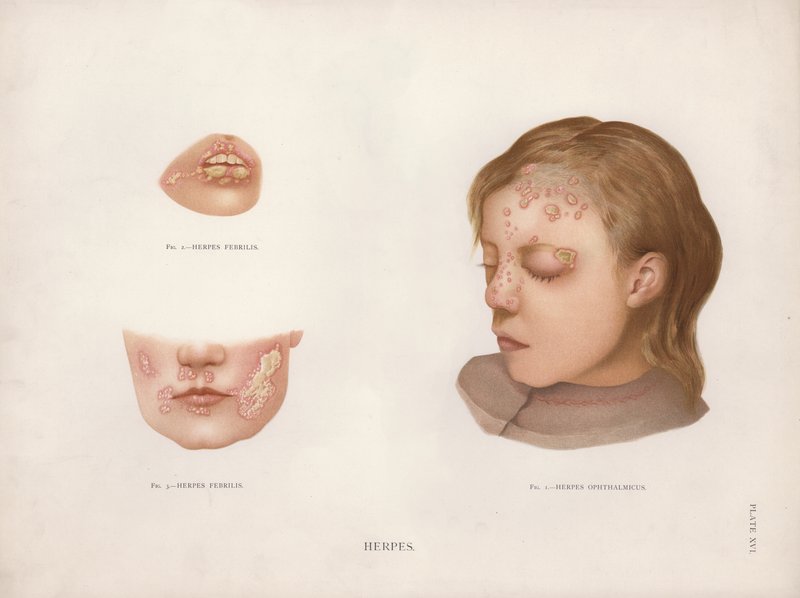 Kožní onemocnění: Herpes (barevné lito) od English School