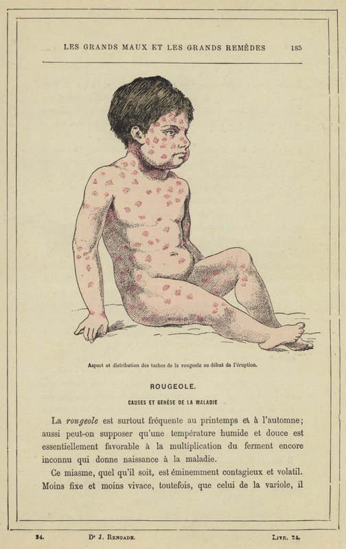 Vzhled a distribuce skvrn po spalničkách na začátku erupce (barevné lito) od French School
