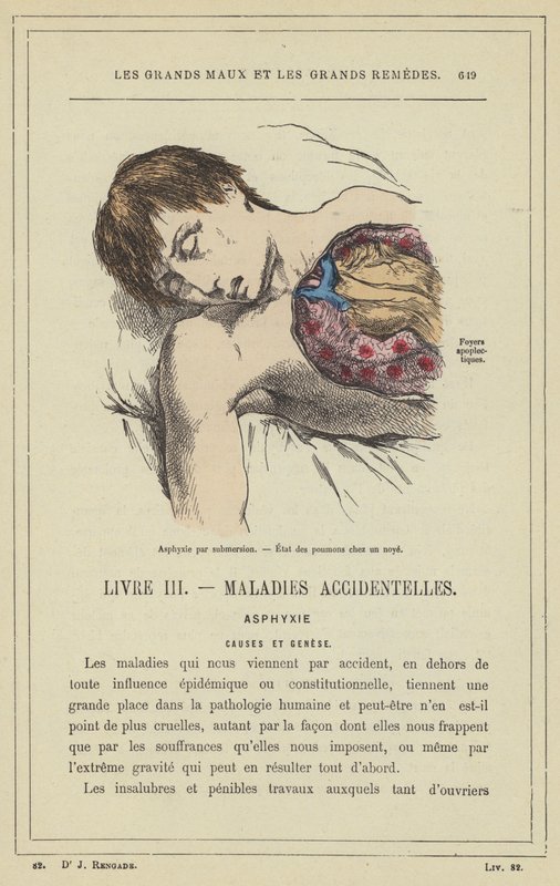 Asfyxie ponořením, stav plic při tonutí (barevné lito) od French School