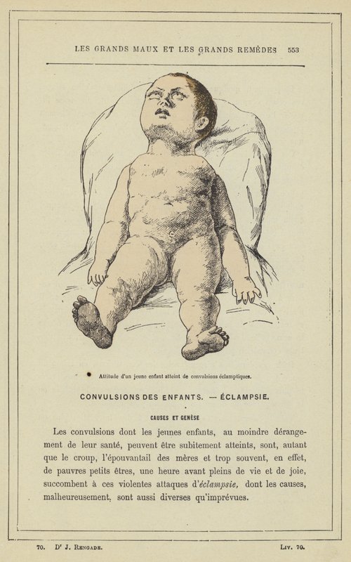 Postoj malého dítěte s eklamptickými křečemi (barevné lito) od French School