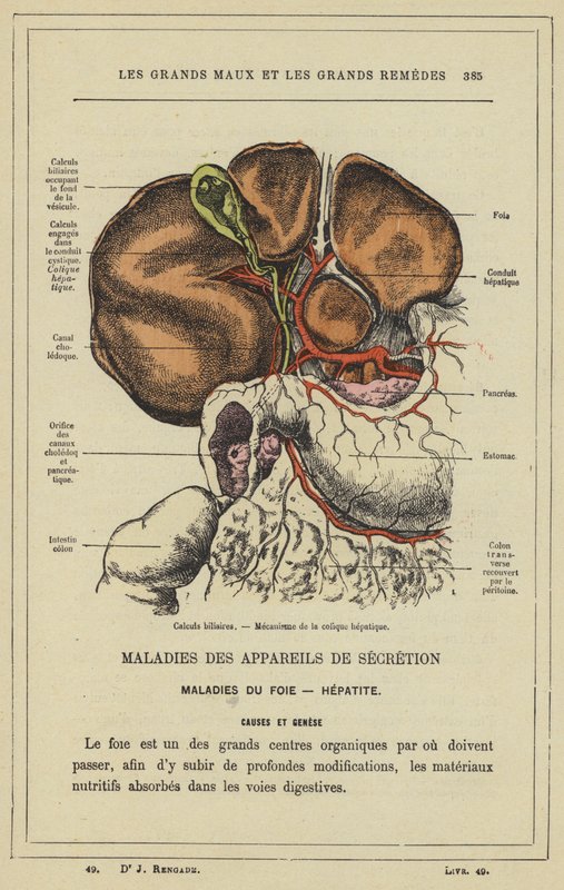 Žlučové kameny, mechanismus jaterní koliky (barevné lito) od French School