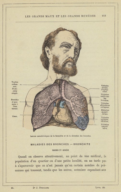 Léze charakteristické pro bronchitidu a bronchiální dilataci (barevné lito) od French School