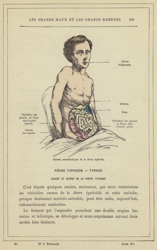 Charakteristické léze břišního tyfu (color litho) od French School