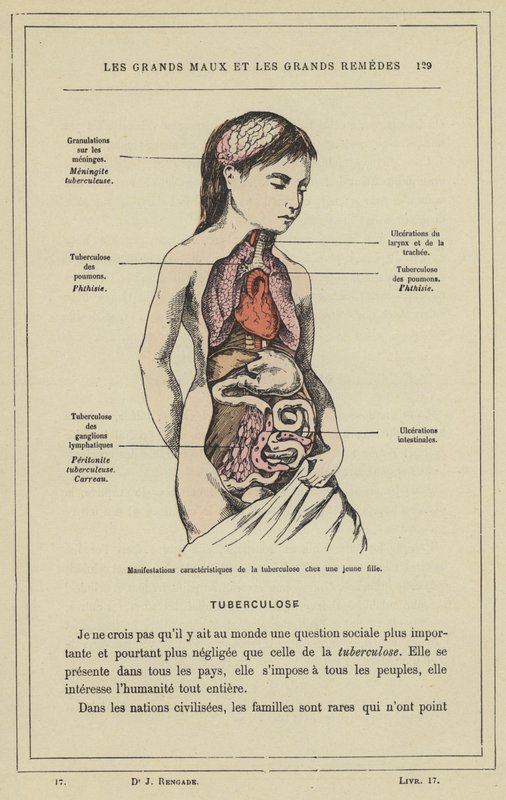 Charakteristické projevy tuberkulózy u mladé dívky (barevné lito) od French School