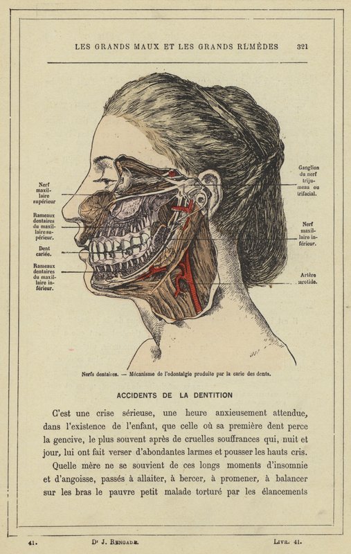 Zubní nervy, Mechanismus odontalgie produkovaný zubním kazem (barevné lito) od French School