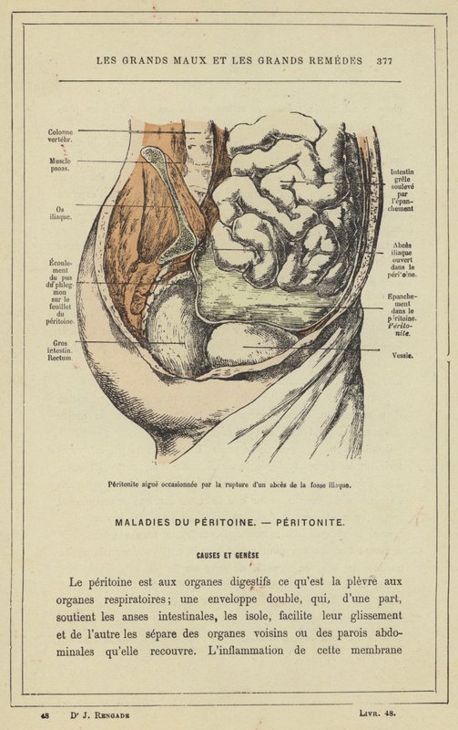 Akutní peritonitida způsobená rupturou abscesu ilické jamky (barevné lito) od French School
