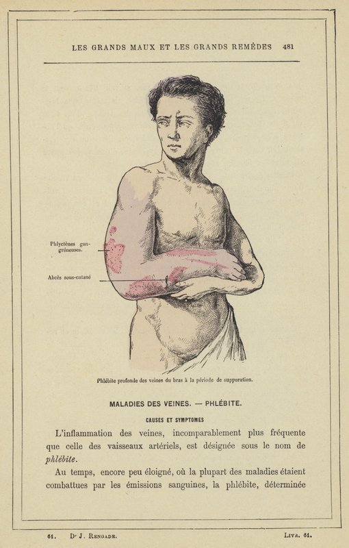 Hluboká flebitida žil paže v období hnisání (barevné lito) od French School