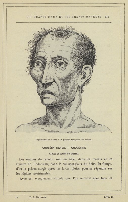 Fyziognomie pacienta během asfyxického období cholery (barevné lito) od French School