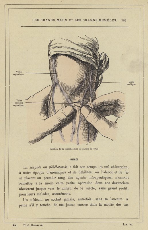Poloha lancety v krvácení z paže (barva lito) od French School