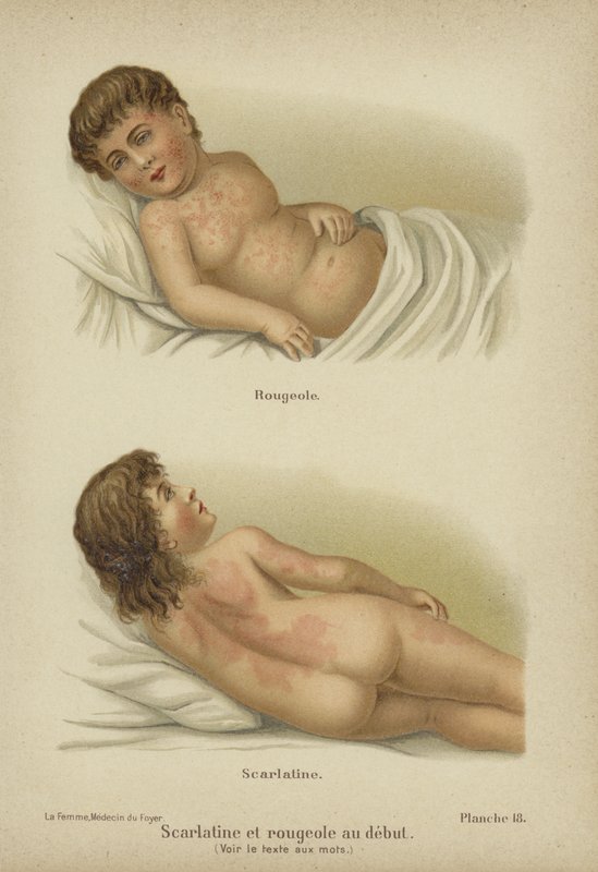 Časné příznaky spalniček a šarlatové horečky (color litho) od German School