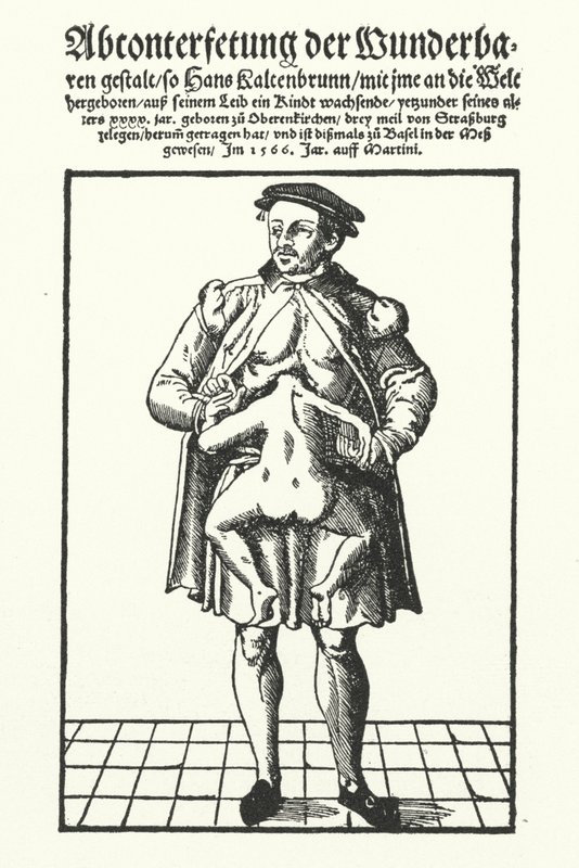 Hans Kaltenbrunn a jeho nevyvinuté siamské dvojče (rytina) od German School
