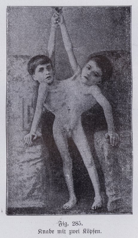 Giacomo a Giovanni Battista Tocci, italská siamská dvojčata (černobílá fotografie) od Italian Photographer