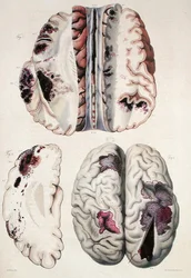 Kapilární apoplexie, z „Anatomie Pathologique du Corps Humain“ od Jean Cruveilhier (1791-1874) 1828-42 (barevná rytina)