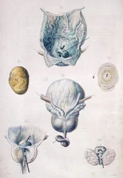 Nemoci močového měchýře a prostaty, z „Anatomie Pathologique du Corps Humain“ od Jean Cruveilhier (1791-1874) 1828-42 (barevná rytina)
