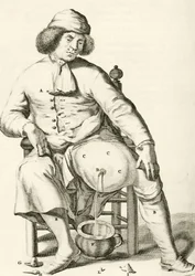 Vypouštění tekutiny z abscesu Frederik Dekkers, 1694