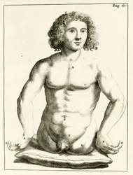 Příklad vrozených vrozených vad od Frederika Dekkerse, 1694