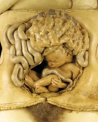 Anatomický model ovariálního těhotenství, detail (vosk) (viz také 1126545-7)
