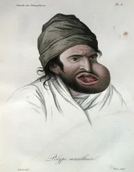 Maxilární polyp, z knihy barona Jean Louis Alibert (1768-1837) 1817 (barevná rytina)