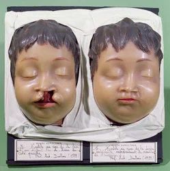 Model zobrazující dětský obličej před a po operaci korekce zaječího rtu, kterou provedl Antoine Dubois (1756-1837) v roce 1799 (vosk)