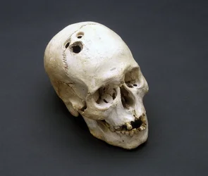 Trepanovaná lebka z doby bronzové, Jericho, Palestina, 2200-2000 př. n. l.
