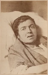 Hysterická epilepsie, kontrakce obličeje, deska VIII z „Iconographie Photographique de La Salpetriere“ od Bourneville a P. Regnarda, Paříž, 1876 (tisk alba)