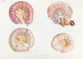 Vnější povrch střev infikovaných cholerou, z Anatomie Pathologique du Cholera Morbus, od Nikolaje Ivanoviče Pirogova (1810-81), publikováno v Petrohradě, 1849