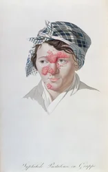 Syphilic cluster pustules, z knihy barona Jean Louis Alibert (1768-1837) 1838