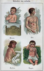 Nemoci dětí: Kopřivka, spalničky, svrab, spála. In „Nová přírodní léčba“ od F.E. Bilze.