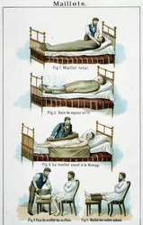 Dresy: 1) Totální dres, 2) Parní lázeň v posteli, 3) Kneippův krátký dres, 4-5) Lýtkový dres – v „Bilz, přírodní léčivo“, konec 19. století